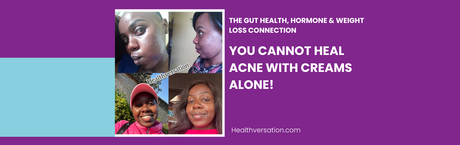 The Real Reason Your Acne Won’t Heal: Gut Health, Hormones and Sustainable Weight Loss Explained